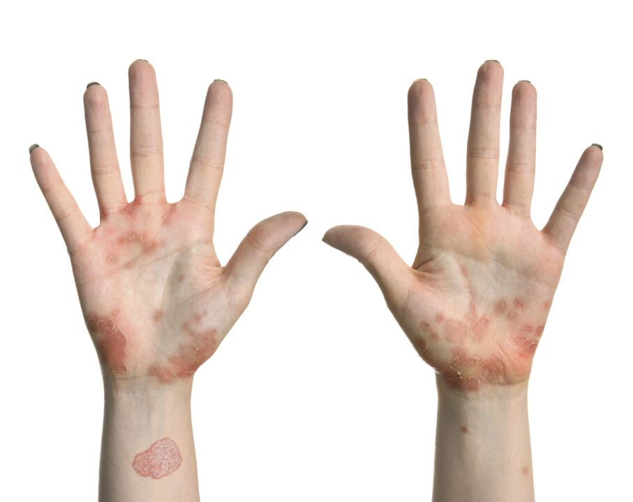 Comharthaí luath psoriasis